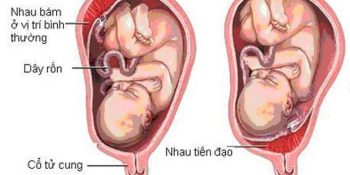 Ra Máu Khi Mang Thai Tháng Thứ 6, BS Cho Biết Gì Update 05/2025