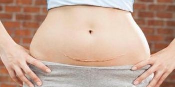 Cảnh Báo: Mổ Thai Ngoài Tử Cung Bao Lâu Có Kinh Và Quan Hệ Lại Được Update 05/2025