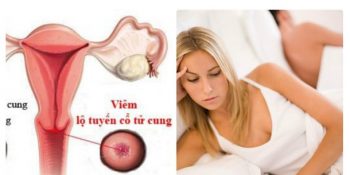 Đốt Viêm Lộ Tuyến Kiêng Ăn Gì? Những Điều Cấn Lưu Ý Sau Khi Update 11/2024