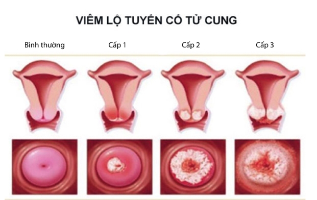 Nên Và Không Nên Ăn Gì Khi Bị Viêm Lộ Tuyến Cổ Tử Cung Update 05/2024