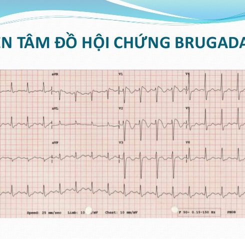 Hội Chứng Brugada: Tiêu Chuẩn Chẩn Đoán Hình Ảnh Điện Tâm Đồ Update 11/2024