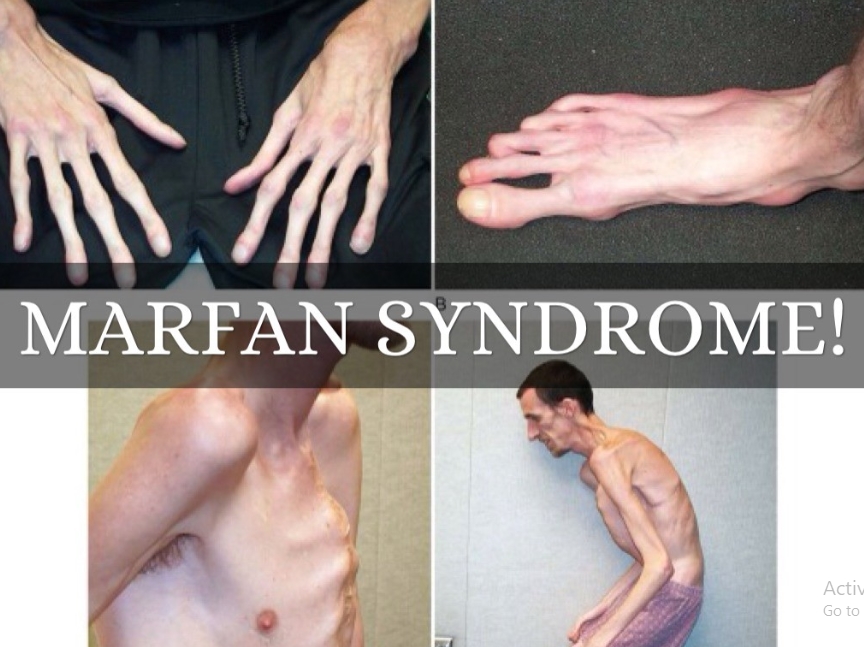 Hội chứng Marfan