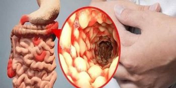 Crohn: Nguyên Nhân, Triệu Chứng, Chẩn Đoán Và Điều Trị Update 03/2025