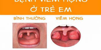 Trẻ Bị Viêm Họng Cấp, Sốt Cao Nhiều Ngày Liên Tục Có Nguy Hiểm Không? Update 03/2025