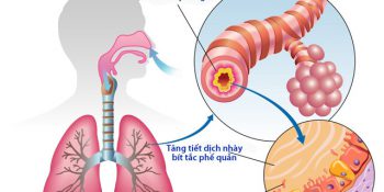 Trẻ Bị Viêm Phế Quản Có Nguy Hiểm Không, Bao Lâu Thì Khỏi Update 03/2025