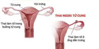 Chậm Kinh, Niêm Mạc Tử Cung Dày 16mm Có Thai Không? Update 10/2024