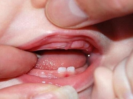 Trẻ mọc răng hàm trong bao lâu